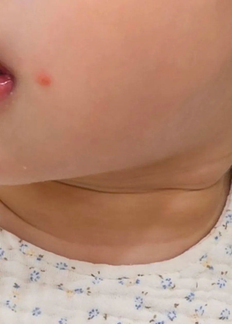 18개월 아기 수족구인 줄 알았던 발진! 원인, 증상, 예방법, 치료...