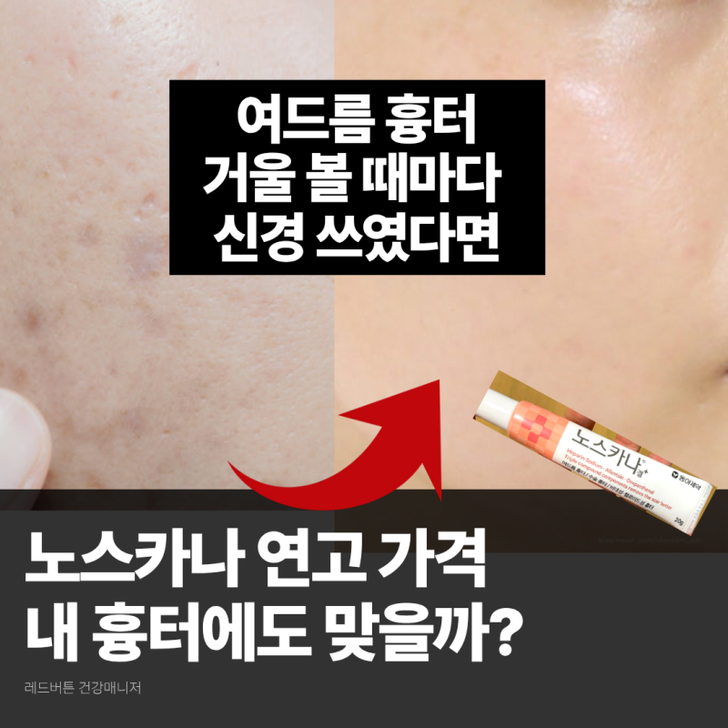 노스카나 연고 가격 알아보다가 알게 된 여드름 흉터 이야기