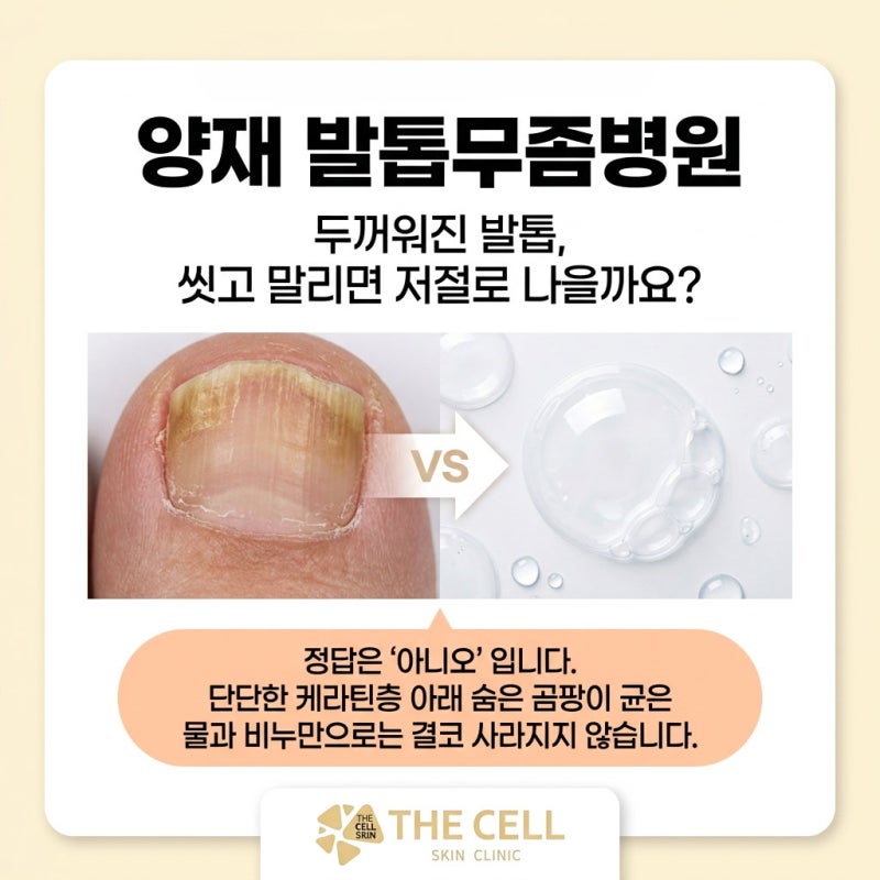 양재 발톱무좀병원, 두꺼워진 발톱이 저절로 낫지 않는 이유