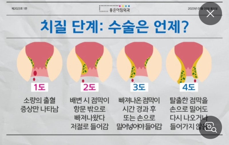 [출산 후 치질] 4기 치질(복합 치핵) 수술 후기