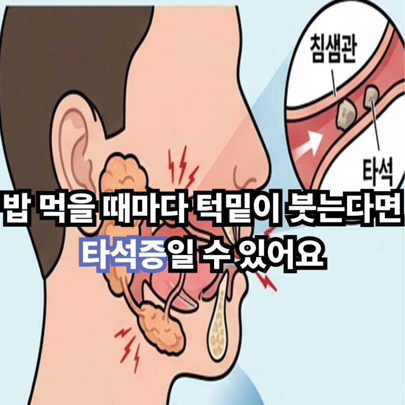 밥 먹을 때마다 턱밑이 붓는다면 타석증일 수 있어요