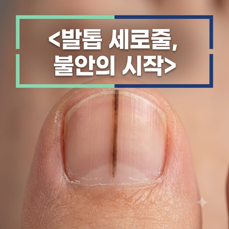 발톱 세로줄 검은색 변형 흑색종 의증 조직검사 비용 실비 청구 방법