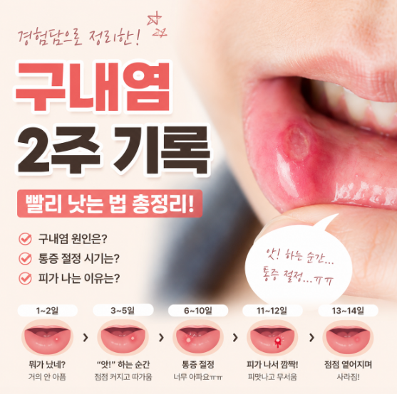 구내염 빨리 낫는 법! 2주 동안 직접 겪은 회복 과정 총정리