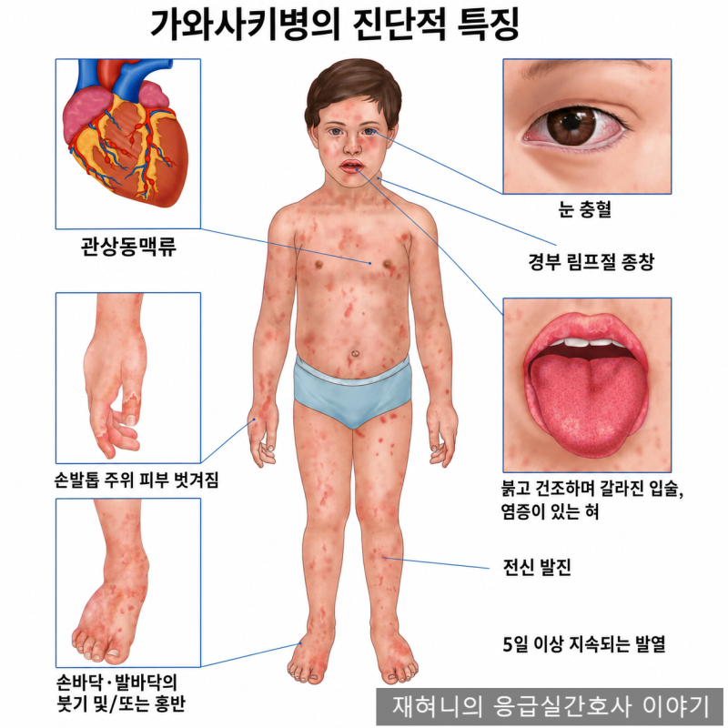 가와사키병 증상과 치료 면역글로불린 아스피린 소아응급실 처치