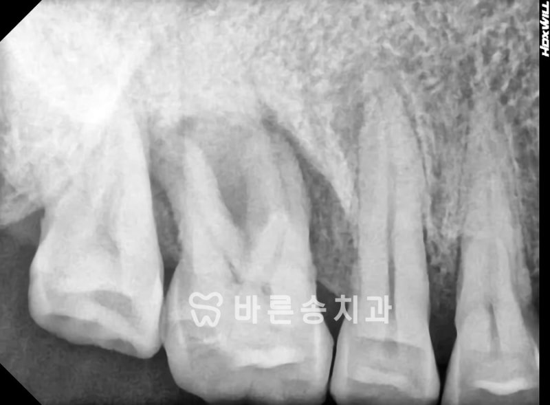 신경치료 후 왜 크라운을 씌워야 하나요?