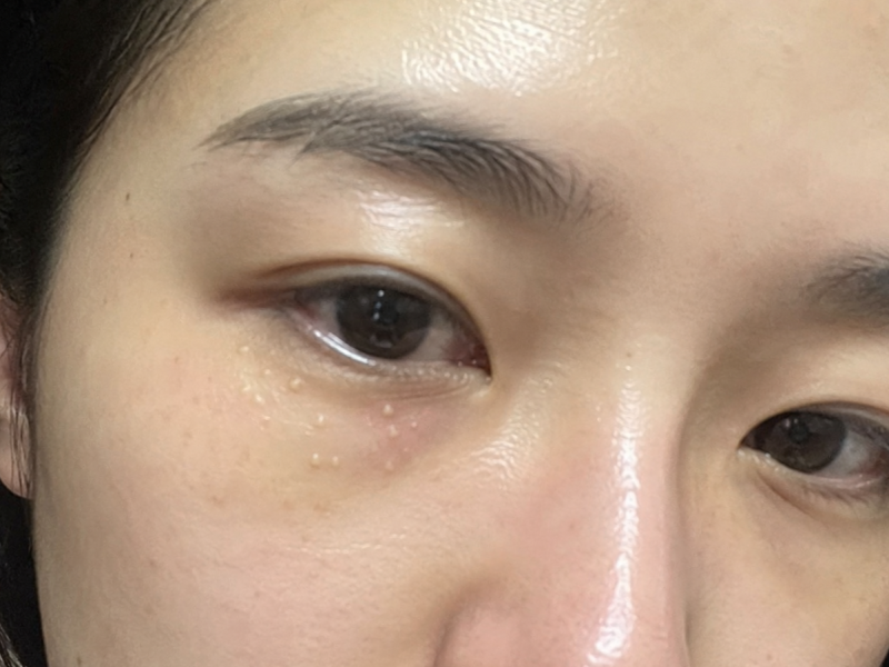 눈밑 한관종 오돌토돌한 돌기가 생겼을 때 확인할 점
