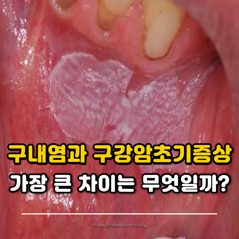 구내염과 구강암초기증상, 가장 큰 차이는 무엇일까?