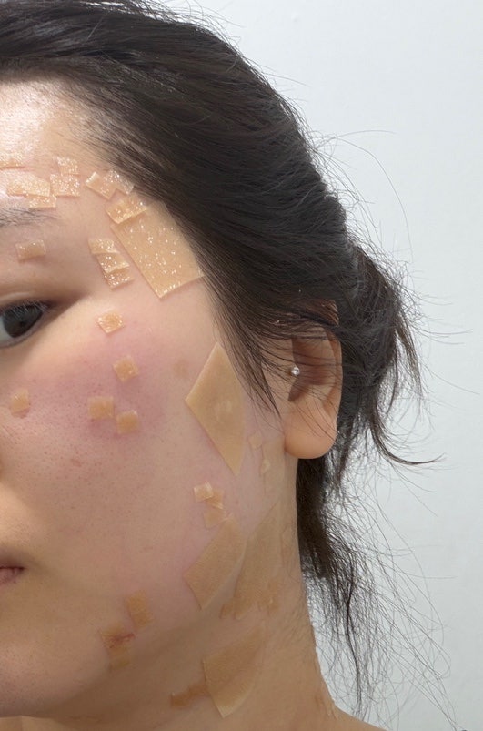 편평사마귀 제거 N회차, 제거 후 관리법 듀오덤 재생크림