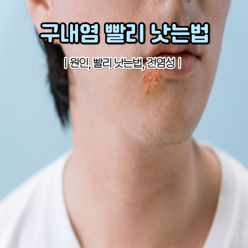 구내염 빨리 낫는법 입병 원인 전염성 있나요?