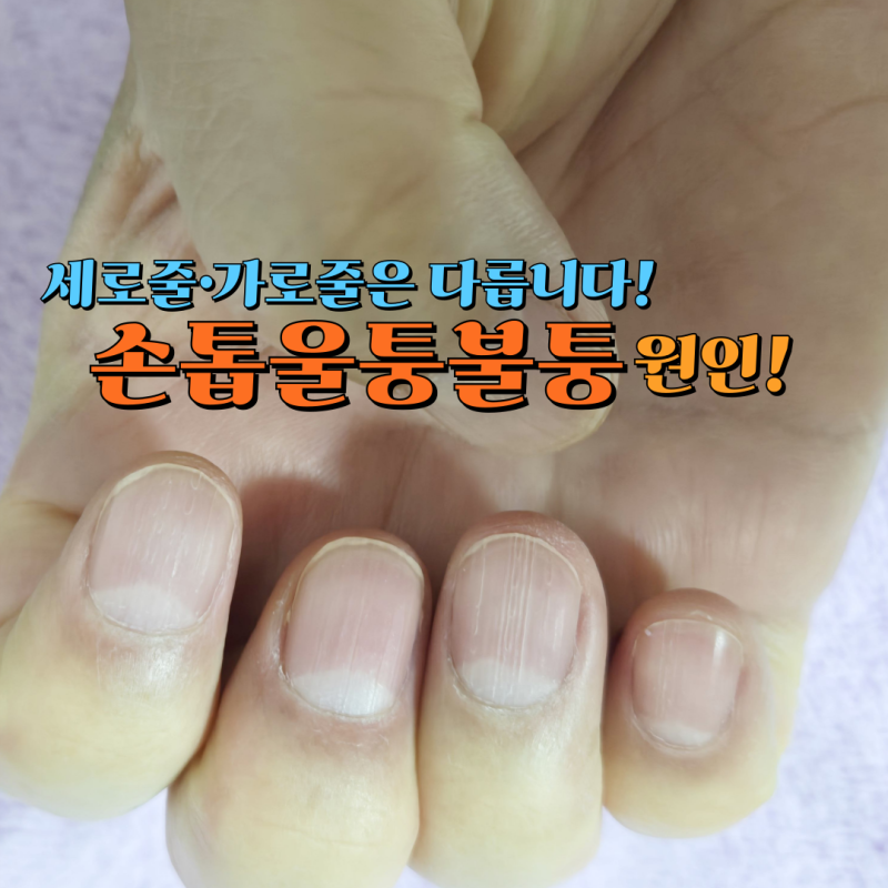 손톱 울퉁불퉁 왜 이럴까? 세로줄과 가로줄이 다른 이유