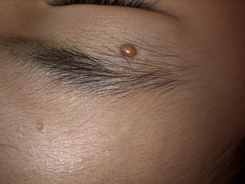 소아 얼굴물사마귀 제거 후 흉터, 아이 엄마의 속상한 마음… 근본 원인은 이것입니다