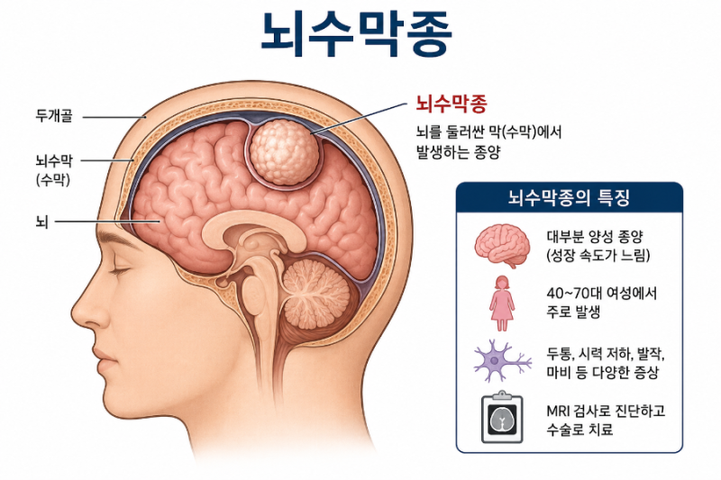 "두통, 시력저하, 경련..." 양성이라도 안심하면 안 되는 '뇌수막종'의 크기에 따른 증상, 종류....