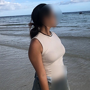 대구 팔뚝 지방흡입 한달차 되니 후회된다...진작할 걸! (+실밥제거,병원후관리,수술전후)