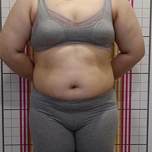 고도비만다이어트, 고혈압 동반 비만 20대 여성의 3개월 관리 과정
