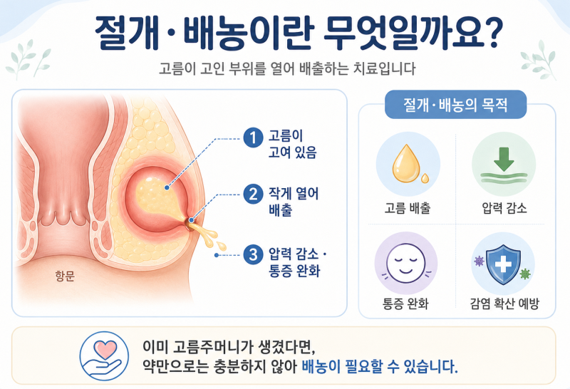 항문농양은 왜 빨리 치료해야 할까?(절개/배농이 필요한 경우)