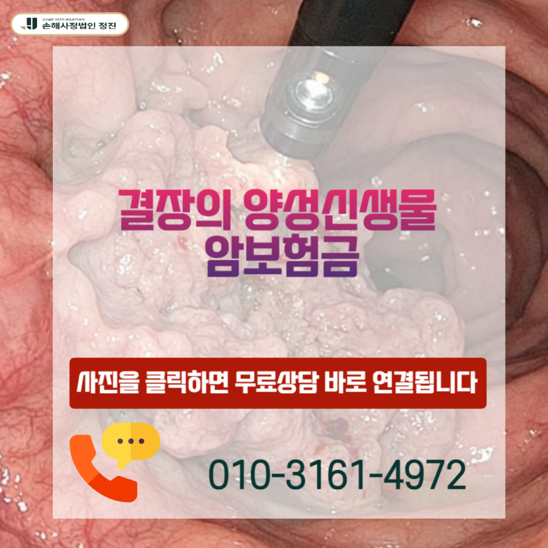 결장의 양성신생물 암보험금, D12 코드를 받고도 유사암 진단비를 수령할 수 있는 방법은 무....