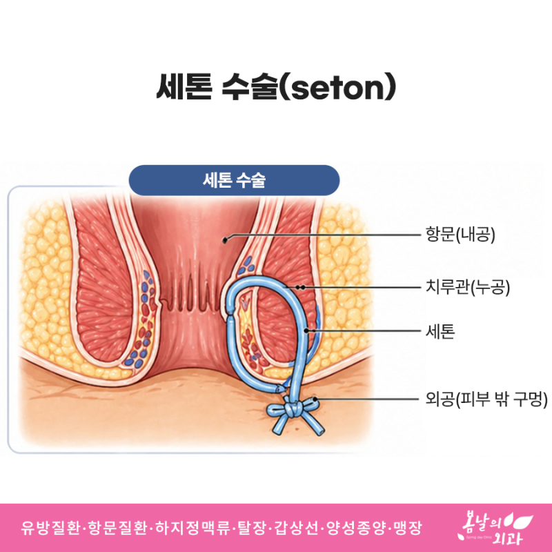 발산 치루 증상 및 치료법, 치질과의 차이