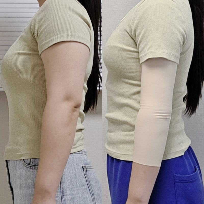 팔뚝지방흡입 내돈내산 생각보다 안 아파서 놀란 통증과 멍 변화 일주일차 리얼 후기