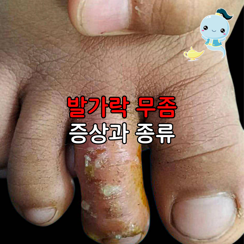 발가락 무좀 증상 종류, 제가 직접 관리하며 알아본 무좀약 치료법 총정리