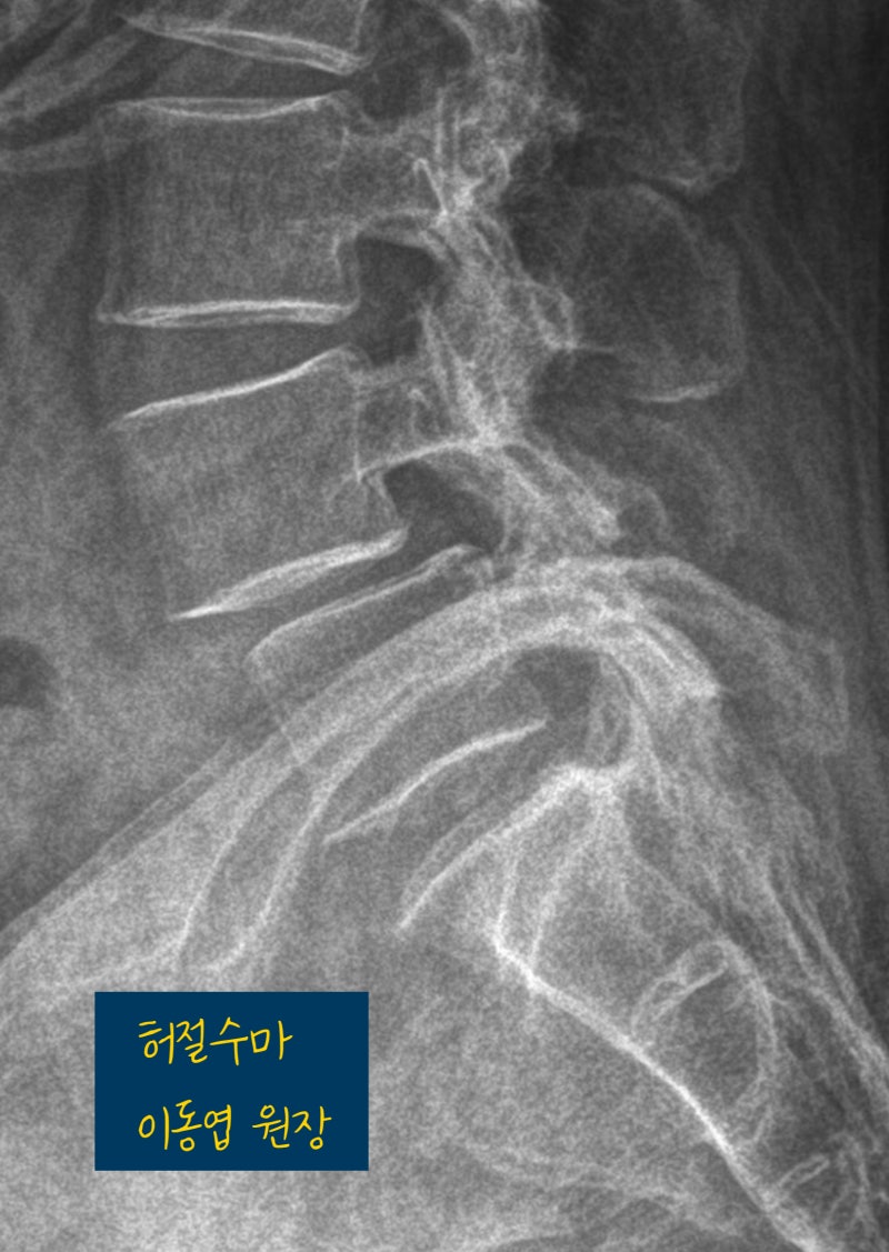척추전방전위증에 좋은 운동, 스트레칭 필라테스 코어운동 재활PT 해도 될까요?