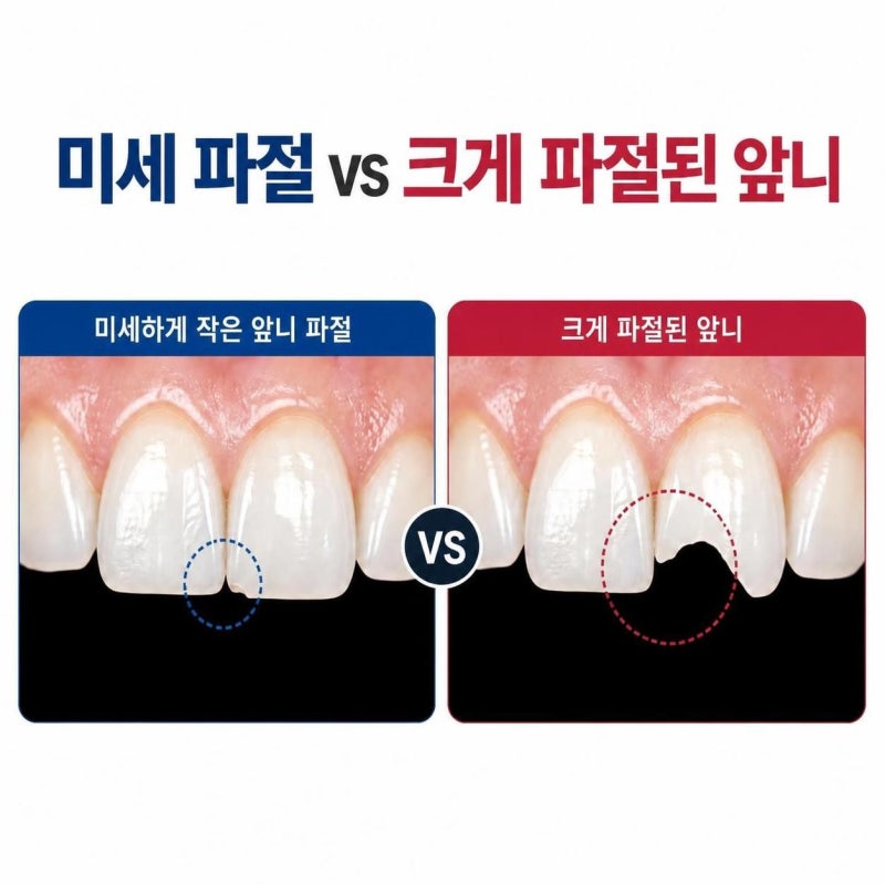 앞니 깨짐, 레진 치료가 가능한 경우와 비용이 달라지는 이유