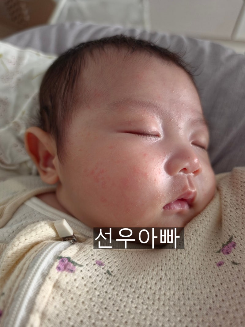 신생아 좁쌀 여드름 비판텐 발라도 될까?