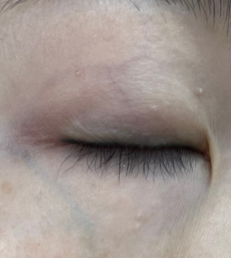 [산후관리] 부천 편평사마귀 성지_출산 후 얼굴에 생긴 편평사마귀, 한관종 제거 후기