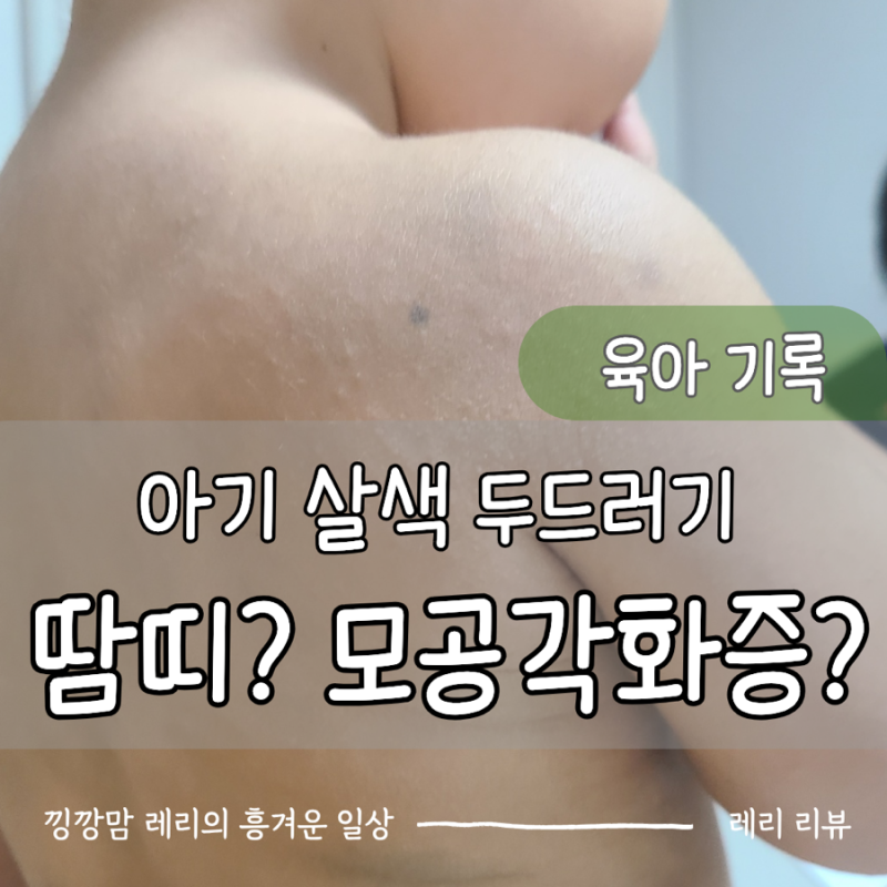 살색 오돌토돌 아기 땀띠와 모공각화증 비교! 여름철 아기 피부 관리법
