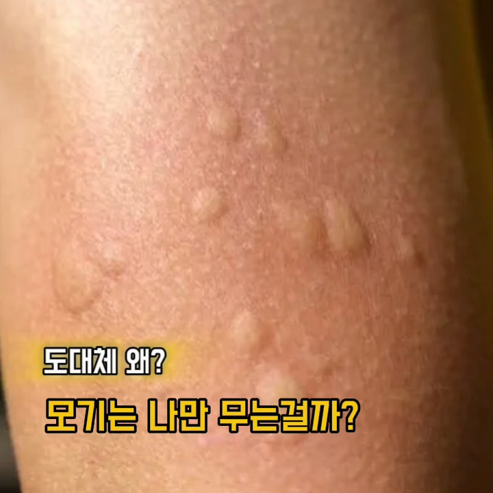 주변사람은 안물리는데 나만 물리는 모기 진짜이유는 뭘까?
