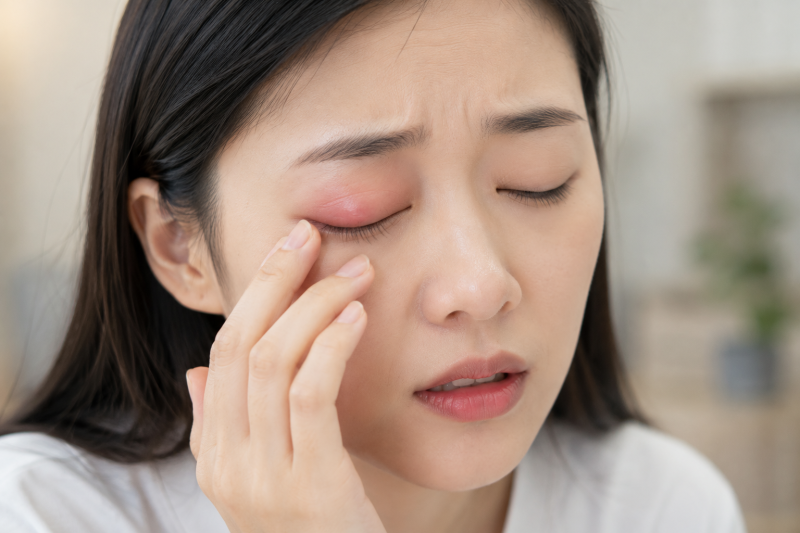 눈 다래끼 빨리 낫는 법, 안쪽·겉쪽 다래끼 증상 차이, 부산서면안과 가야 하는 경우는?