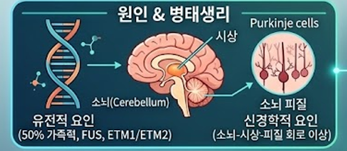 본태떨림 ET 정말 흔한 운동 질환 중의 하나
