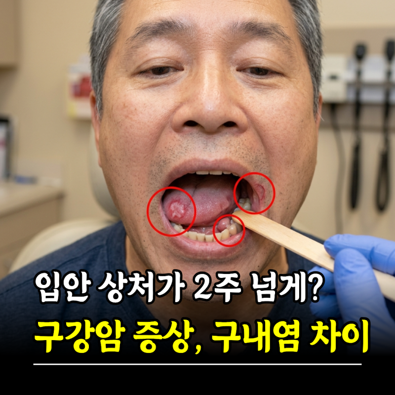 입안 상처가 2주 넘게? 구강암 증상, 구내염과 차이