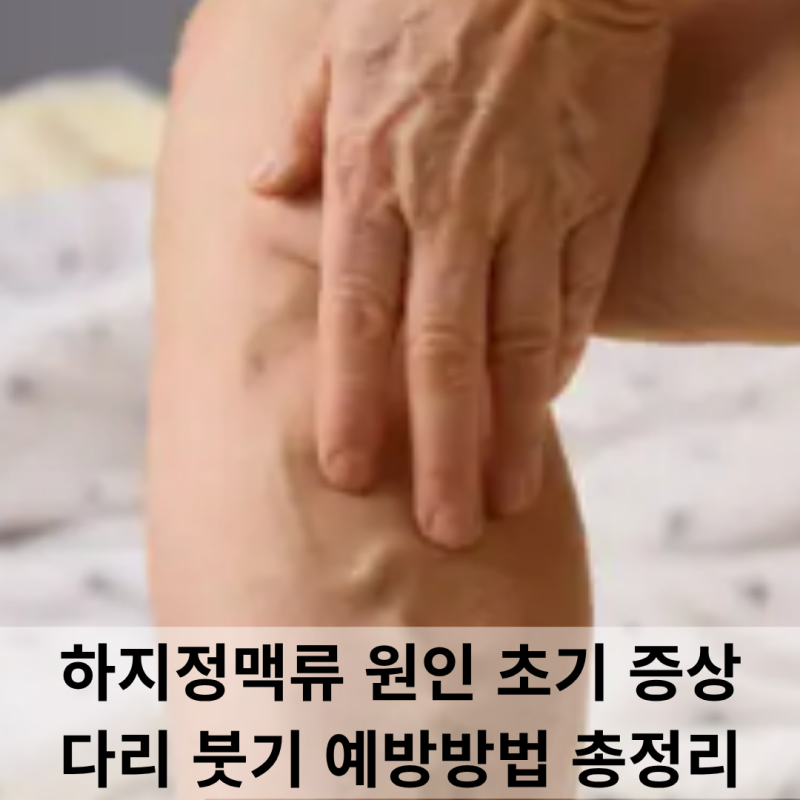 하지정맥류 원인부터 초기 증상까지! 다리 붓기 예방하는 운동 총정리