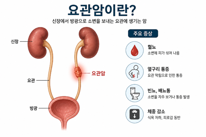 "반복되는 혈뇨와 옆구리 통증" 방광염과 비슷한 증상을 가진 '요관암'의 원인, 증상, 진단, ....