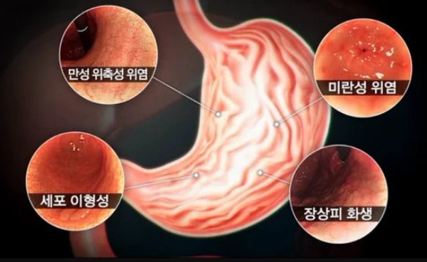 미란성 위염 뜻 증상 알고 관리해야죠