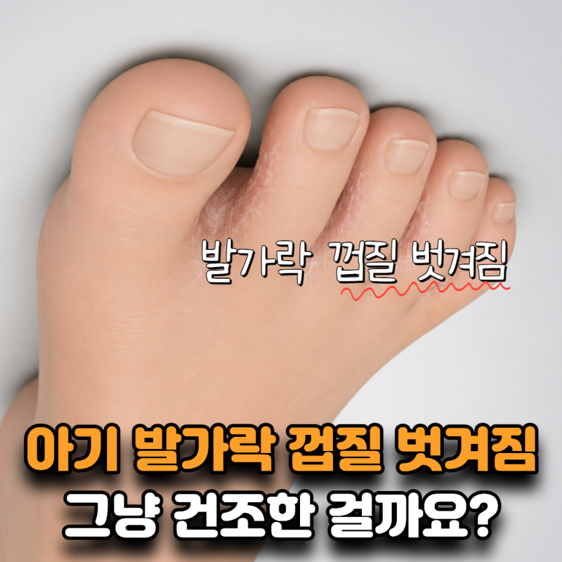 “그냥 건조한 줄 알았는데…” 아기 발가락 껍질 벗겨짐 신호 4가지