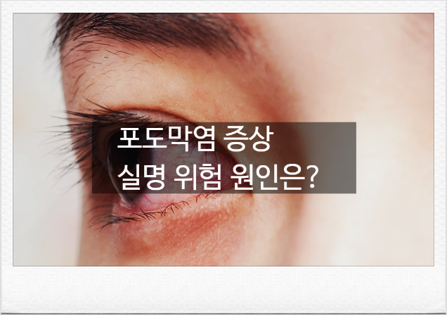 [포도막염 증상] 실명 유발하는 눈 속 염증, 백내장과 오해하기 쉬운 초기 징후와 원인