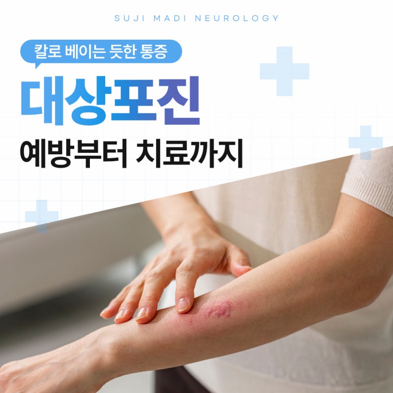 [수지 대상포진] 초기 통증을 그냥 넘기면 안 되는 이유