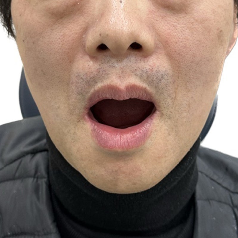 여주임플란트, 치아가 하나도 없을 때 풀아치가 대안이 될까요?