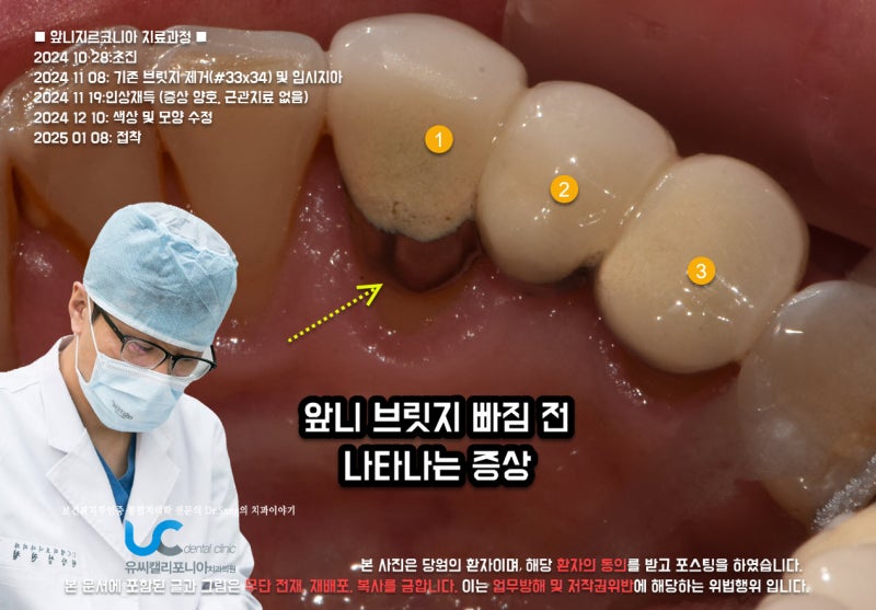 치아 앞니 브릿지 빠짐 원인찾아 새로 해서 수명 연장해야
