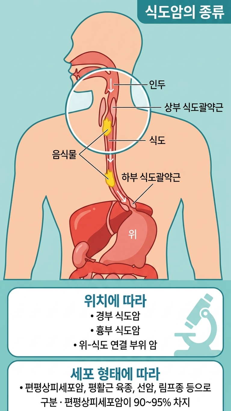 식도암 생존율과 예방법, 놓치면 안 되는 이유