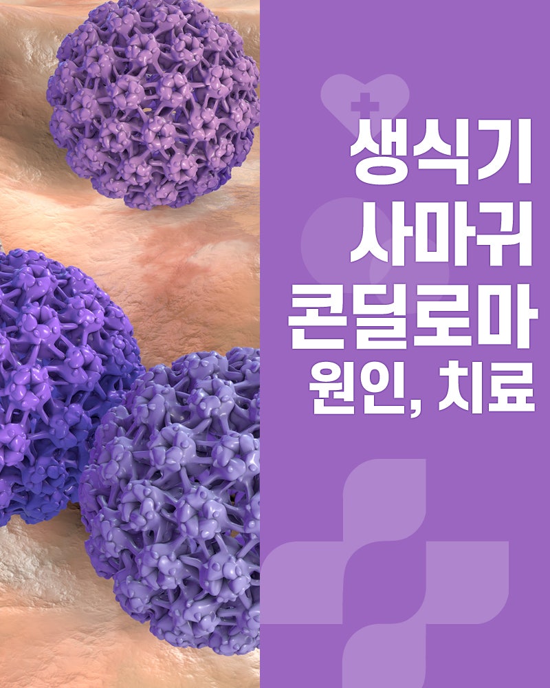 생식기 사마귀, 콘딜로마(곤지름) 원인과 치료법 /부천여성병원