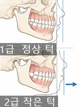 2급 부정교합, 돌출입교정·무턱교정·과개교합까지 함께 보는 이유