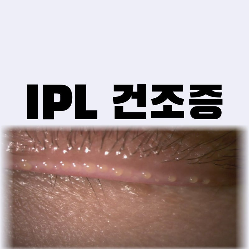 안구건조증 인공눈물로 안 낫는다면? IPL 레이저 치료 효과와 진짜 후기