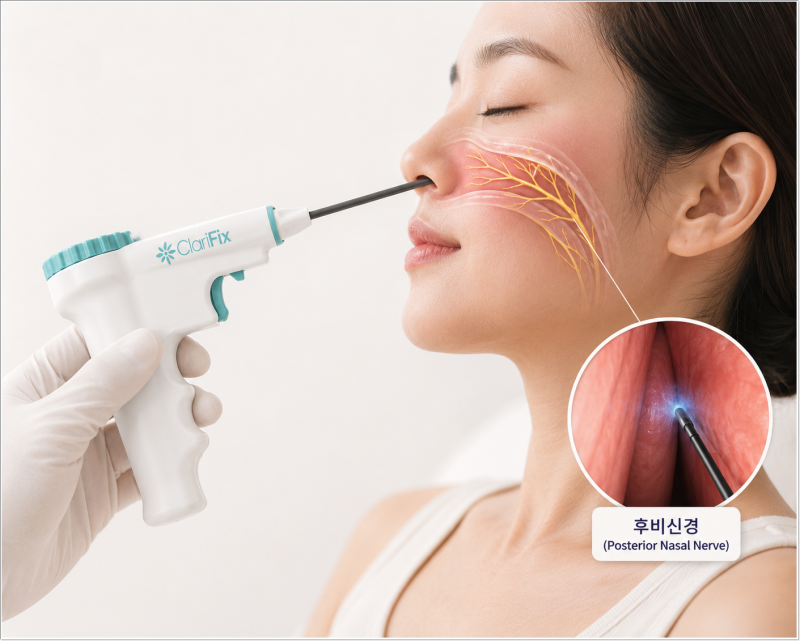 비염냉동치료, 반복되는 비염이라면 약만 계속 먹어도 괜찮을까요?