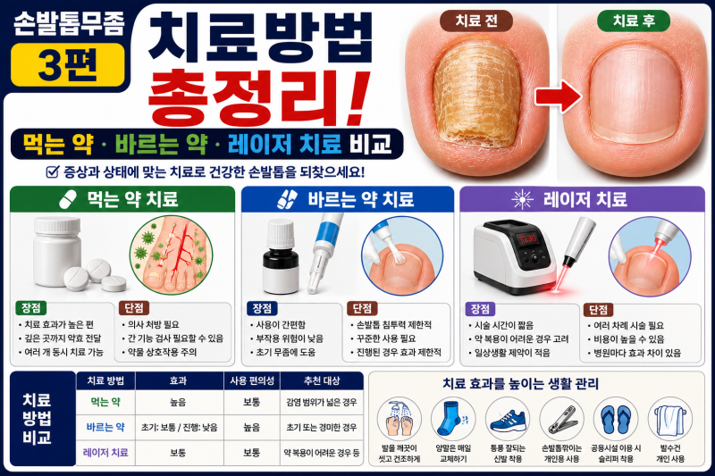 3. 손발톱무좀 치료방법 총정리, 먹는약/ 바르는 약/ 레이저 치료 비교