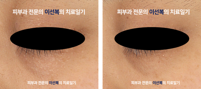 "한관종", 치료방향을 어떻게 정해야할까? (피부과전문의 칼럼)