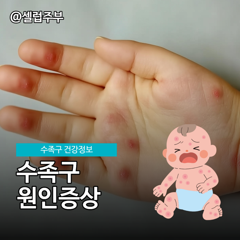 수족구 증상 원인, 수족구병 격리 기준!