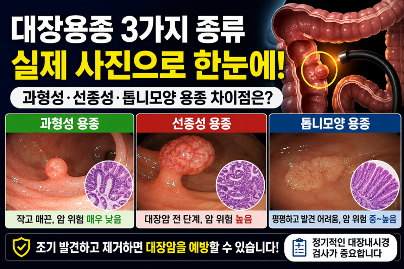 대장용종(폴립)은 왜 생길까요? 원인부터 예방까지
