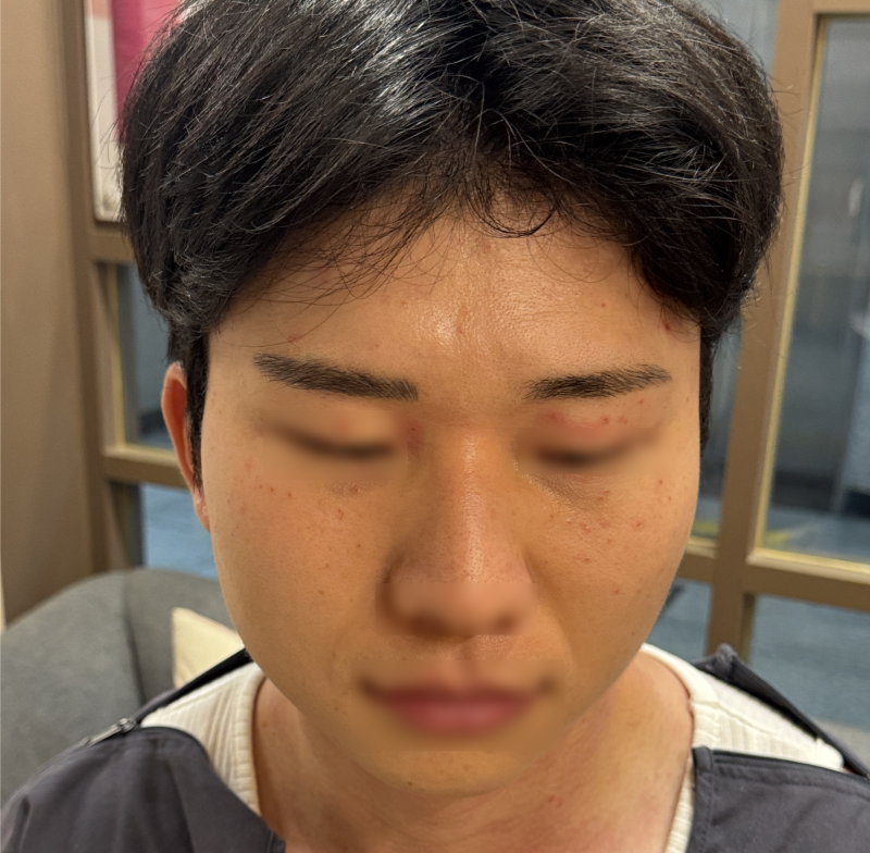 부천 상동역 편평사마귀 제거 무제한, 남자친구 얼굴 싹 정리하고 왔어요!